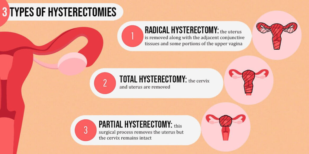 hysterectomy-side-effects-procedures-and-recovery